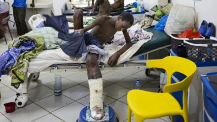 Shukurani Konde Tuva (g),  souffrant d'une nécrose des tissus de sa jambe gauche causée par le venin cytotoxique provenant de la morsure d'une vipère heurtante, est pris en charge à l'hôpital du sous-comté de Malindi, le 7 avril 2025 au Kenya