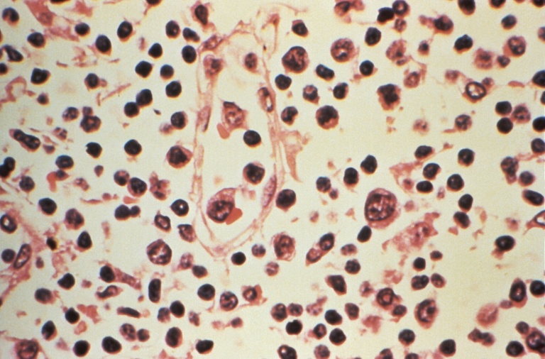 Photo non datée, obtenue le 6 mai 2026 des Centres américains de contrôle et de prévention des maladies (CDC), montrant au microscope des détails histopathologiques d'un prélèvement de ganglion lymphatique effectué chez un patient suspecté d'être atteint d'une infection à hantavirus