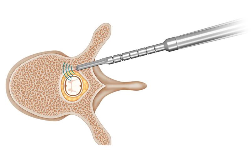 SpineGuard et Omnia Medical annoncent la conclusion du transfert des actifs de SpineGuard Inc.